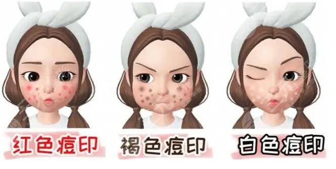 復合彩光祛痘需要多少錢?