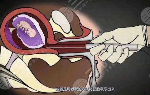 人流手術(shù)具體是怎么操作的?