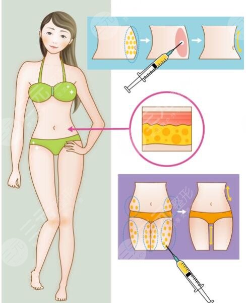 等離子激光溶脂有危害嗎？對(duì)身體有傷害嗎？副作用是什么？怎么果？