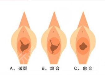 處女磨修復(fù)