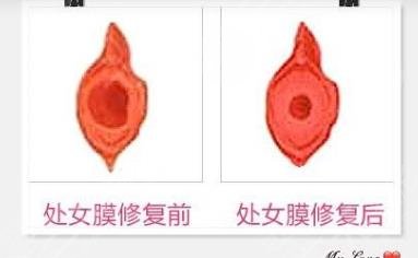 處女磨修復(fù)