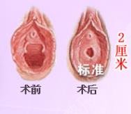 處女磨修復(fù)