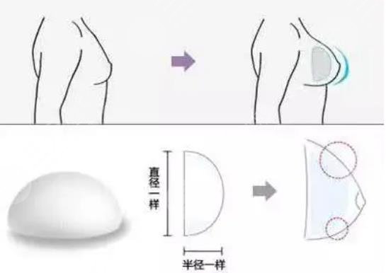 曼托豐胸