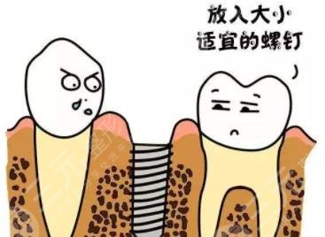 牙齒種植