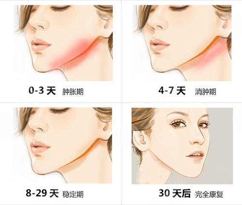 下頜角切除多少錢?