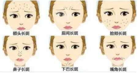 醫(yī)美祛斑方法