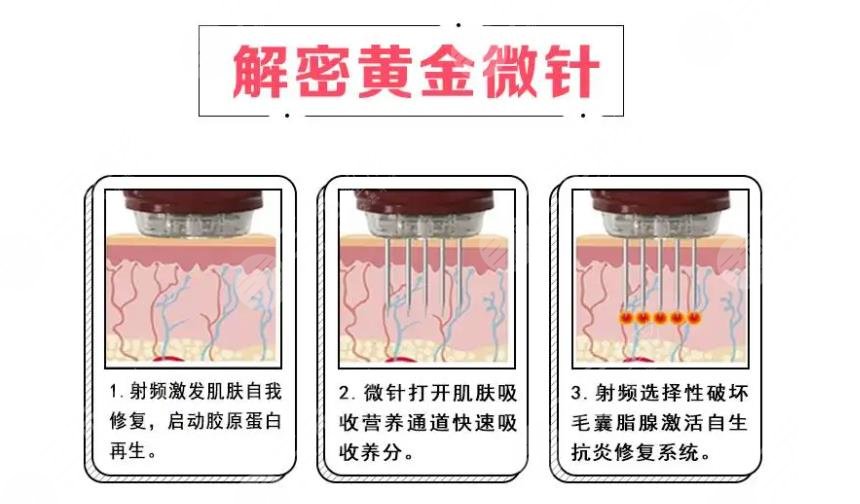 去痘價格大概多少?