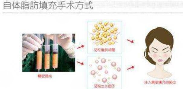 全臉脂肪填充的優(yōu)勢