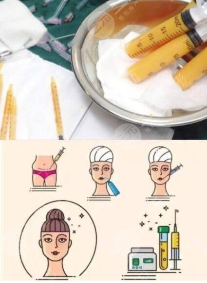 全臉脂肪填充的優(yōu)勢