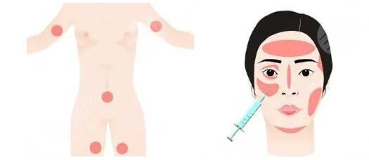 全臉脂肪填充的注意事項