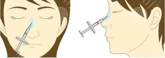 玻尿酸隆鼻對比圖前后！顏值提升僅僅需要幾分鐘，醫(yī)院內(nèi)部人員都在打卡~