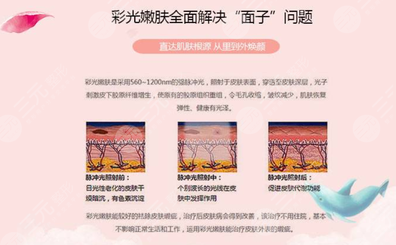 復(fù)合彩光緩解多少錢？