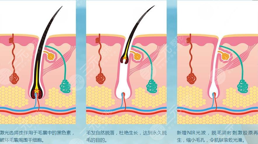 脫毛嫩膚的方法有哪些？