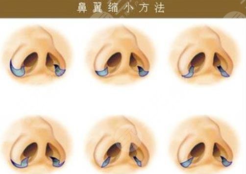 鼻翼縮小