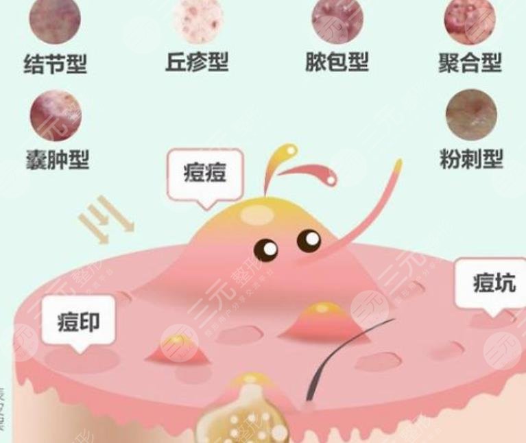 長(zhǎng)痤瘡