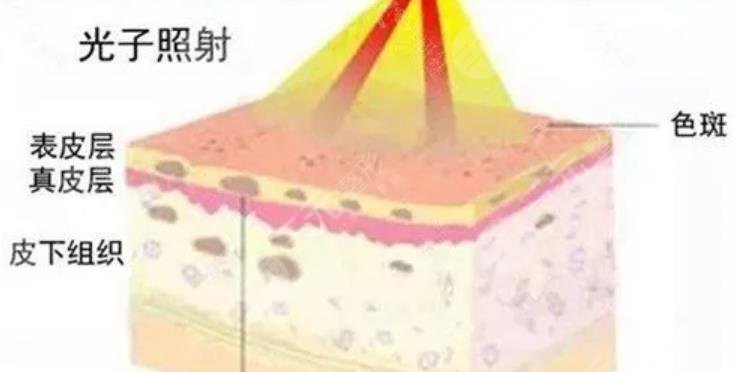 光子嫩膚