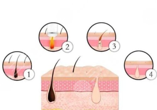 shr冰點脫毛價格影響因素
