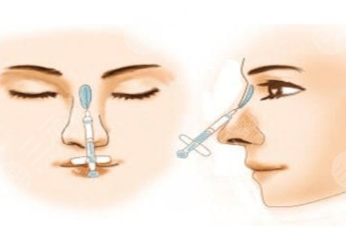 硅膠假體隆鼻一般維持多久?