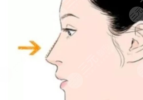 硅膠假體隆鼻一般維持多久?