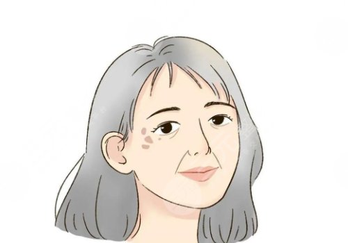 怎樣治老年斑？