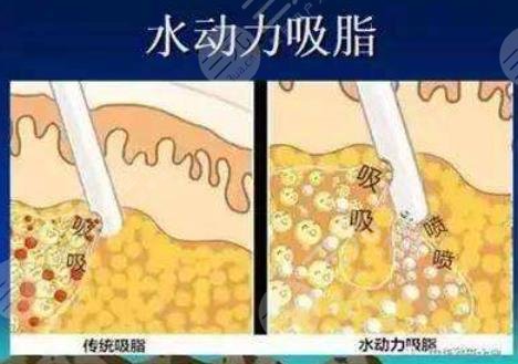 水動(dòng)力吸脂