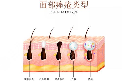 如何有緩解痤瘡?