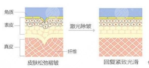 激光除皺
