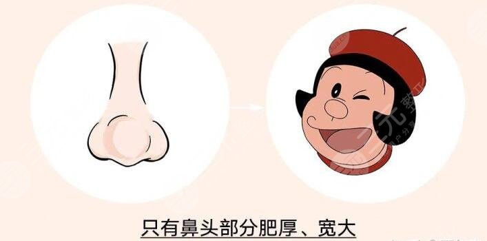 　　蒜頭鼻整形前后對比，小編通過調(diào)查了解到，有許多小伙伴正在飽受蒜頭鼻帶來的不好的影響，蒜頭鼻又被稱為大鼻頭，無論男生還是女生，一旦長成蒜頭鼻，就會讓整個人看起來面部的不協(xié)調(diào)，影響美觀程度，而且如果鼻頭很大的話，咱們看這個人的大部分眼光就會集中在鼻頭，并且忽略面部其他地方。除此之外，蒜頭鼻的小伙伴們在化妝的時候也會感到特別煩惱。所以有一些小伙伴會去做蒜頭鼻整形手術(shù)，收獲一個小巧好看的鼻頭。  　　一、蒜頭鼻整形手術(shù)原理  　　蒜頭鼻的形成原因是因為鼻頭部分的脂肪組織比較厚，鼻翼的軟骨發(fā)育過度或者鼻翼軟骨發(fā)育過程中往后縮，從而造成了蒜頭鼻。在進行蒜頭鼻矯正手術(shù)的過程當(dāng)中，醫(yī)生是通過切除鼻子部分多余的軟骨和脂肪組織，然后將鼻頭聚攏縫合，在傷口愈合過后，就可以收獲一個又細又直的小巧好看的鼻子。這類手術(shù)的切口微小，傷口不，愈合過后也不容易看出切口的痕跡，愛美的小伙伴可以詳細去了解蒜頭鼻整形手術(shù)，判斷自己的鼻頭形狀，再進行手術(shù)改良。  　　二、蒜頭鼻的分類  　　首先咱們的鼻翼軟骨發(fā)育過度會導(dǎo)致蒜頭鼻，這樣的蒜頭鼻整個人的鼻頭看起來又大又大，的不好看，但是改良的方法是比較簡單的，可以直接將發(fā)育過度的鼻翼軟骨切除掉，或者可以將鼻翼軟骨聚攏再縫合，也能達到收縮鼻翼的果。其次是鼻頭的軟組織肥厚，造成的蒜頭鼻，這種蒜頭鼻的特征是，起來肉乎乎的軟綿綿的。  　　要進行手術(shù)調(diào)整的話，就需要切除鼻子的部分軟組織，這種改良手術(shù)考驗醫(yī)生的手術(shù)技術(shù)，如果醫(yī)生在手術(shù)過程當(dāng)中操作不當(dāng)?shù)脑挘秃芸赡軙?dǎo)致鼻頭的軟組織增生，會讓鼻頭越來越大，變成大蒜頭鼻。后就是鼻尖很矮，就會顯得鼻頭很塌，這類蒜頭鼻就不需要切除鼻部組織，可以通過抬高鼻尖來達到縮小鼻翼的果，這類改良方式是相對來說簡單的。  　　三、蒜頭鼻整形前后對比  　　小編的大學(xué)室友就是一個典型的蒜頭鼻女孩，不看鼻頭的話，她皮膚白皙有光澤，眼睛大雙眼皮嘴巴小巧，臉型也是標(biāo)準(zhǔn)的鵝蛋臉，看起來的好看，但是美中不足的是，她的鼻頭看起來的大，肉嘟嘟的，也就顯得她的山根很低，這就使得她的顏值降低了百分之五十，特別是嘴巴小巧就更顯得鼻頭大，整個人看起來就不再精致，顯得比較憨厚老實。前段時間，她在朋友的推薦下，準(zhǔn)備通過整形手術(shù)來改良自己的蒜頭鼻。  　　她講述到，她去到了整形醫(yī)院，整形醫(yī)生根據(jù)她的鼻頭設(shè)計了切除鼻部多余軟組織的手術(shù)方案。醫(yī)院安排了一位臨床經(jīng)驗豐富的整形醫(yī)生，為她進行了切除鼻部軟組織的手術(shù)。術(shù)后一周左右，她發(fā)現(xiàn)自己的鼻頭沒有腫脹感了，整體的恢復(fù)也比較快，她自己也感覺到鼻頭的縮小了。  　　術(shù)后一個月左右，她的鼻子已經(jīng)變得的好看，因為肉肉的鼻頭被切除縮小了，也就讓她的山根顯得高挺起來，鼻頭變得小巧精致，整個人的顏值大大的提升，從一個面相憨厚的女生變成了大美女。她本人也變得更加自信，以前拍照只敢露半張臉的她，現(xiàn)在拍照能夠大大方方露全臉，不用再因為自己的蒜頭鼻被家人朋友嘲笑了。  　　小編希望所有和我大學(xué)室友有相同困擾的小伙伴，可以勇敢的面對自己的蒜頭鼻，自信的走進整形醫(yī)院，做一場適合自己的蒜頭鼻整形手術(shù)，從根本上改良自己的顏值，讓自己也能在自己的生活圈里面自信放光芒。