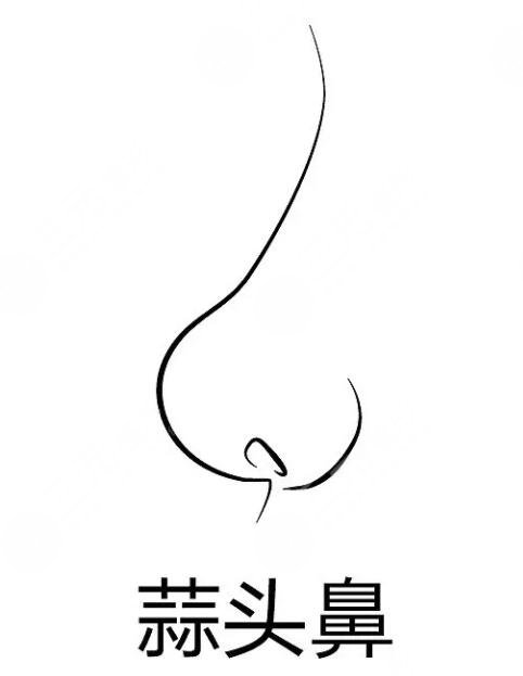 蒜頭鼻整形前后對比