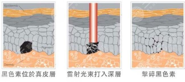 激光祛斑的副作用和危害性