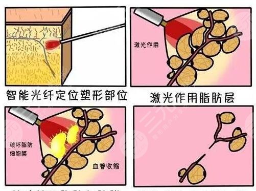 等離子激光溶脂果如何？