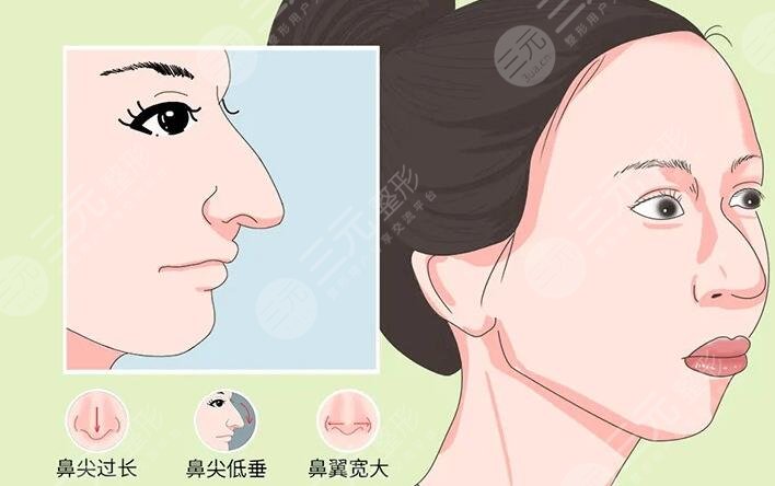 鷹鉤鼻整容整形手術(shù)多少錢2023同步更新！術(shù)前準(zhǔn)備及術(shù)后注意事項(xiàng)牢記于心！