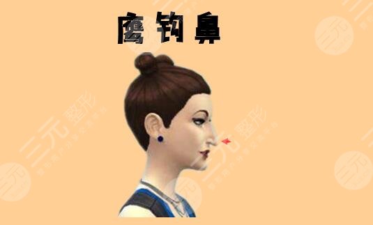 鷹鉤鼻整容整形手術(shù)多少錢2023同步更新！術(shù)前準(zhǔn)備及術(shù)后注意事項(xiàng)牢記于心！