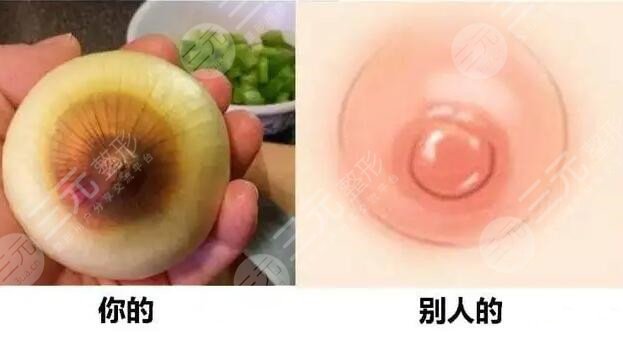 乳暈整形