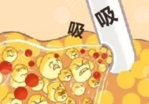 腹部抽脂術(shù)后需要修復幾天才能恢復？
