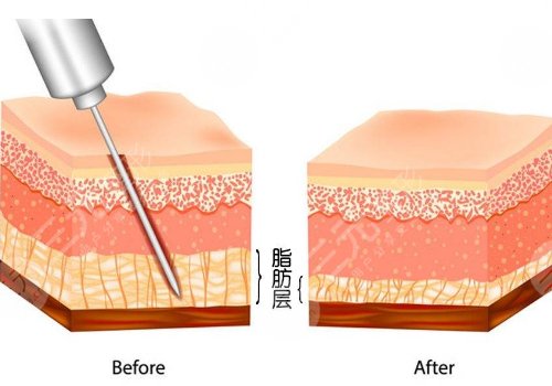 腹部抽脂術(shù)后需要修復幾天才能恢復？