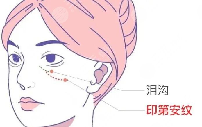 自體脂肪填充淚溝能保持幾年時(shí)間？