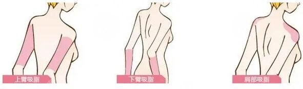 手臂吸脂的恢復(fù)期長(zhǎng)嗎?