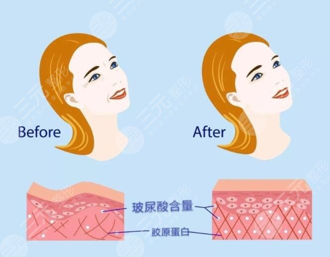 玻尿酸除皺的原理是什么?