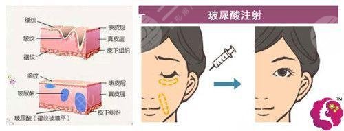 玻尿酸去法令紋需?要多少錢(qián)?