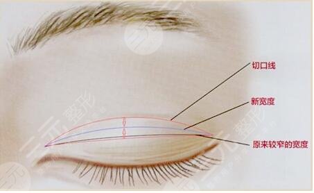 2023雙眼皮修復(fù)多少錢？