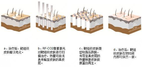 像素激光去痘疤?有用嗎?