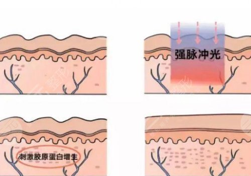 激光美容去疤痕效果怎么樣?