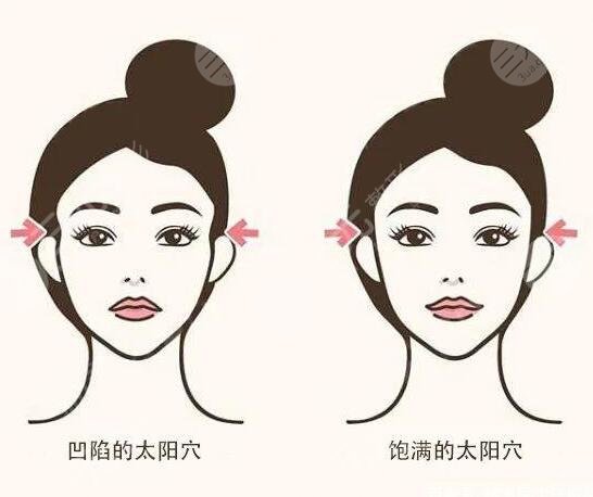豐太陽穴多少錢價格影響因素有哪些?