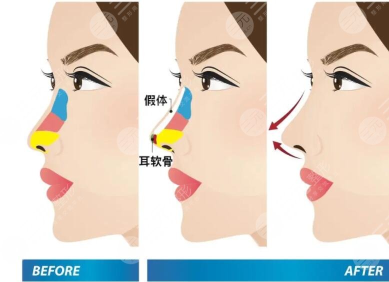 假體隆鼻需要注意什么呢?