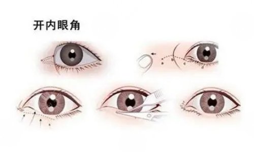 影響開內(nèi)眼角手術(shù)價格的因素有哪些?