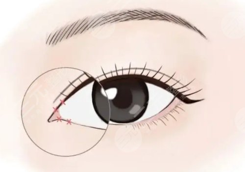 開內(nèi)眼角一般多少錢?