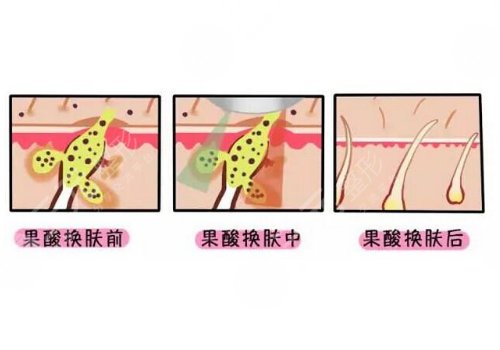黑頭導出液真的有用嗎?