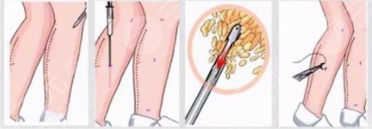 小腿吸脂術(shù)效果好嗎？