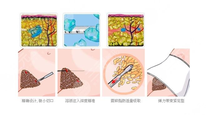 體外超聲吸脂是什?么原理?